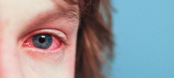 بیماری التحاب ملتحمه چشم