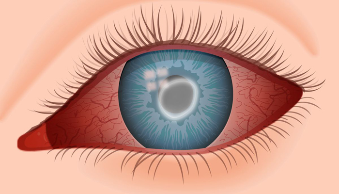 عفونت چشم و لنزهای تماسی