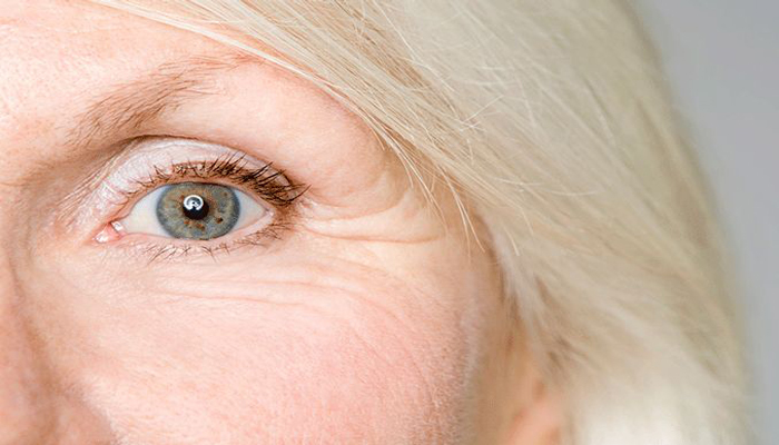 درمان خطوط پنجه کلاغی چشم